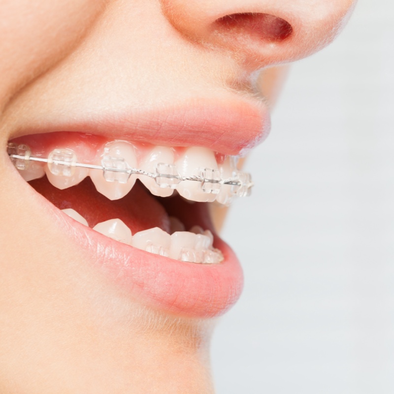 woman wearing clear ceramic braces