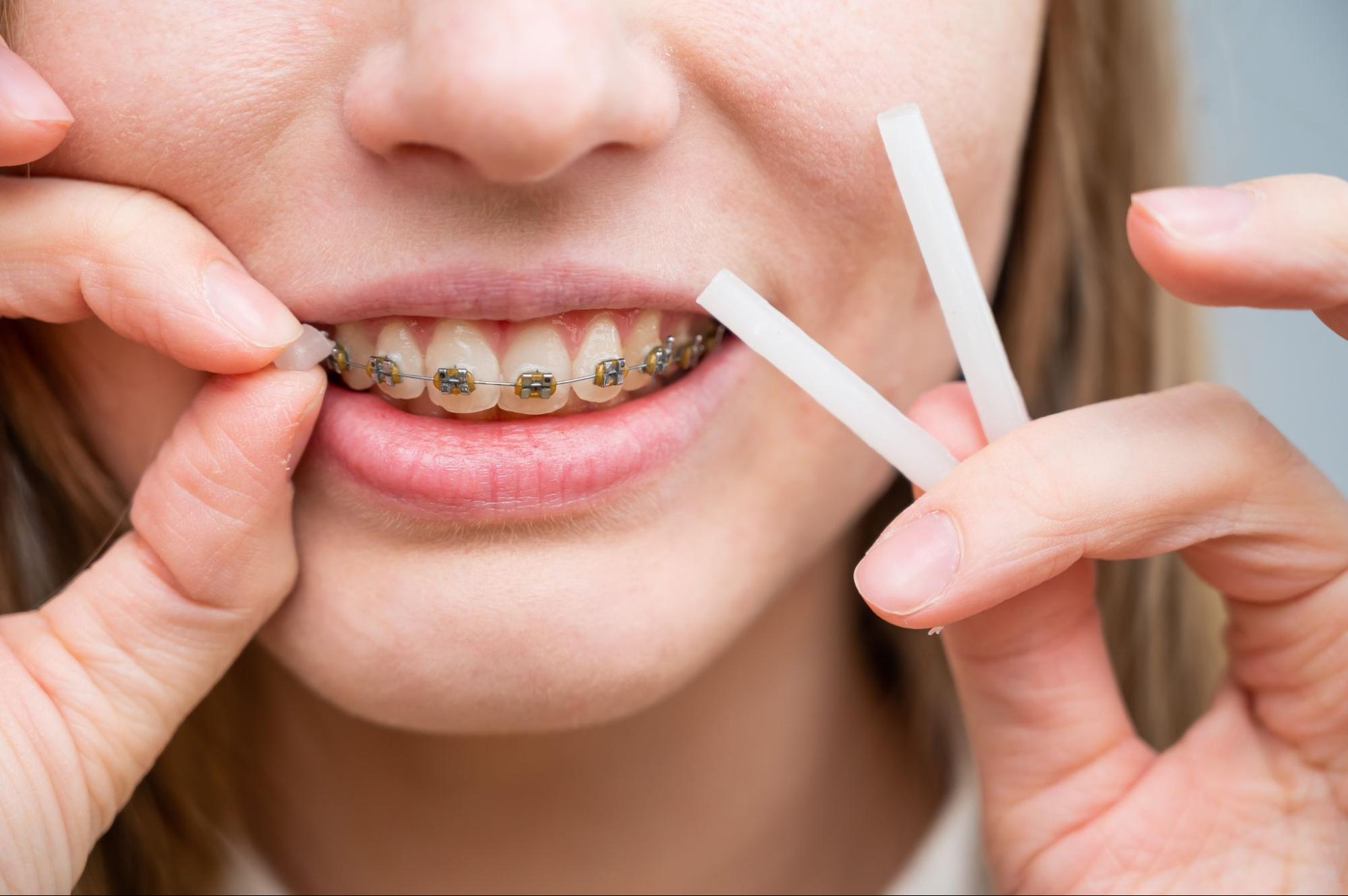 10 Common Braces Issues and How To Handle Them